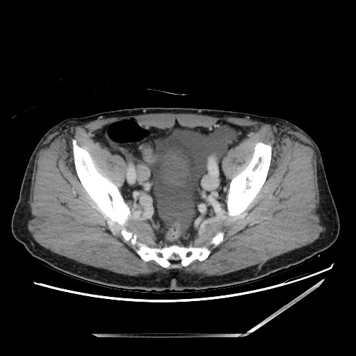 Closed loop small bowel obstruction - omental adhesion causing "internal hernia" (Radiopaedia 85129-100682 A 141).jpg