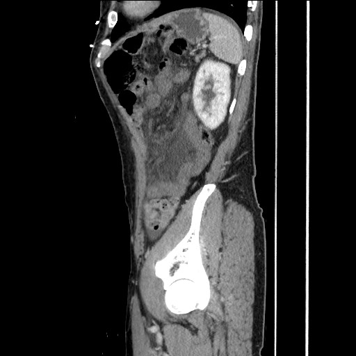 Closed loop small bowel obstruction - omental adhesion causing "internal hernia" (Radiopaedia 85129-100682 C 140).jpg
