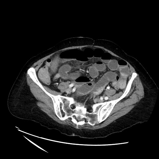 File:Closed loop small bowel obstruction due to adhesive band, with intramural hemorrhage and ischemia (Radiopaedia 83831-99017 Axial 52).jpg