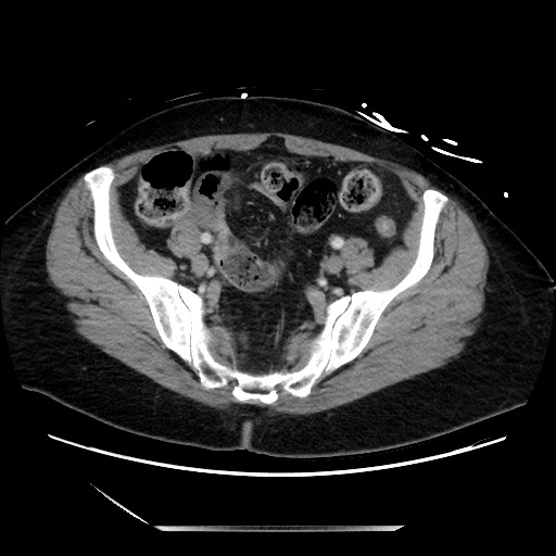 Closed loop small bowel obstruction due to adhesive bands - early and late images (Radiopaedia 83830-99014 A 117).jpg