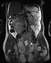 File:Closed loop small bowel obstruction in pregnancy (MRI) (Radiopaedia 87637-104031 Coronal T2 33).jpg