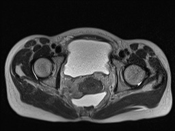 Closed loop small bowel obstruction in pregnancy (MRI) (Radiopaedia 87637-104031 D 36).jpg
