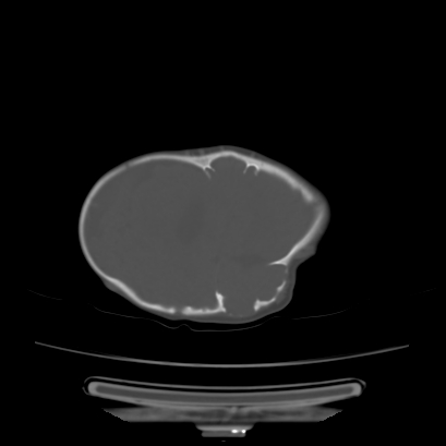 Cloverleaf skull (Radiopaedia 91901-109710 Axial bone window 121).jpg
