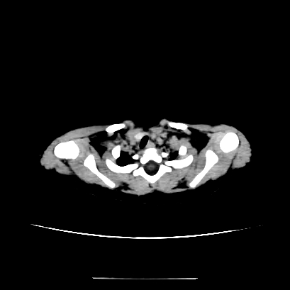 Cloverleaf skull (Radiopaedia 91901-109710 Axial non-contrast 1).jpg