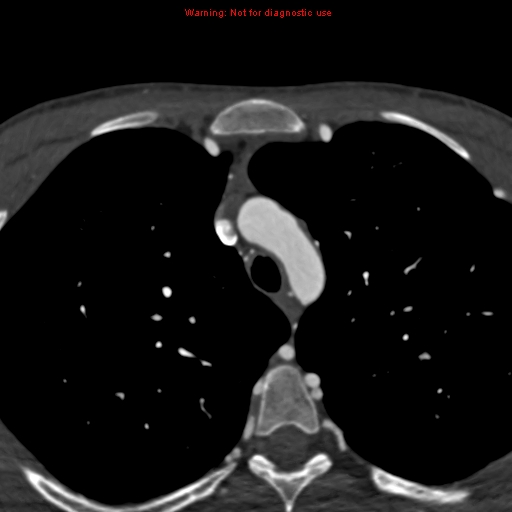 File:Coarctation of the aorta (Radiopaedia 12461-12697 A 43).jpg