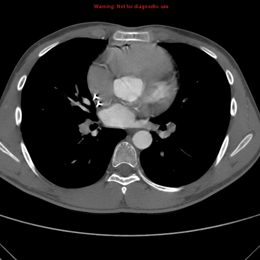 File:Coarctation of the aorta (Radiopaedia 9434-10118 A 103).jpg