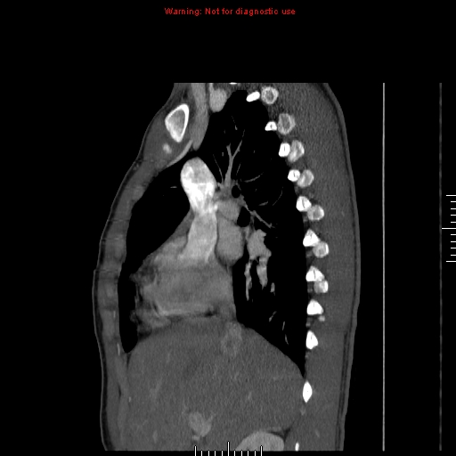 File:Coarctation of the aorta (Radiopaedia 9434-10118 B 17).jpg