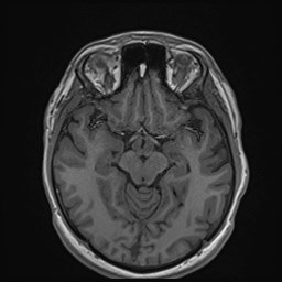 File:Cochlear incomplete partition type III associated with hypothalamic hamartoma (Radiopaedia 88756-105498 Axial T1 89).jpg