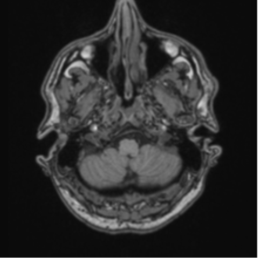 File:Colloid cyst of the third ventricle (Radiopaedia 86571-102662 Axial T1 14).png