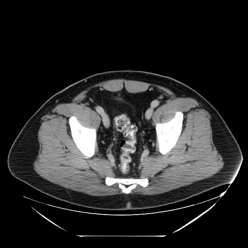 File:Colocolic intussusception due to lipoma (Radiopaedia 73712-84508 Axial 102).jpg