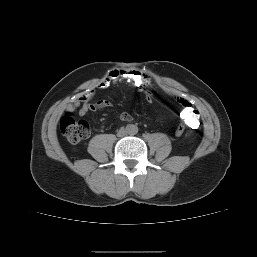 File:Colocutaneous fistula in Crohn's disease (Radiopaedia 29586-30093 D 12).jpg