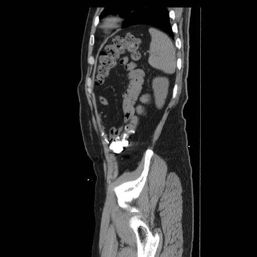 Colocutaneous fistula in Crohn's disease (Radiopaedia 29586-30093 F 46).jpg