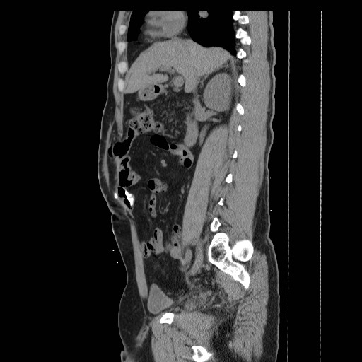 Colocutaneous fistula in Crohn's disease (Radiopaedia 29586-30093 F 6).jpg
