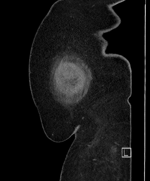 Colon adenocarcinoma (Radiopaedia 59374-66735 C 64).jpg