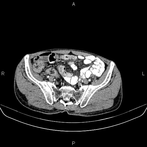 File:Colon adenocarcinoma - hepatic flexure (Radiopaedia 85635-101395 A 74).jpg