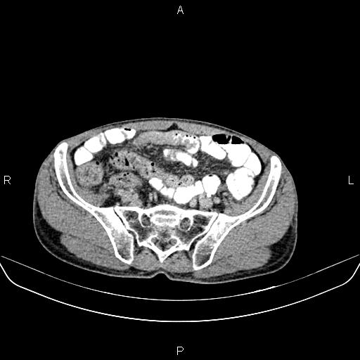 File:Colon adenocarcinoma - hepatic flexure (Radiopaedia 85635-101395 Axial C+ delayed 72).jpg