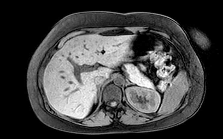 Colon adenocarcinoma with Krukenberg tumors, advanced pregnancy (Radiopaedia 67279-76645 A 63).jpg