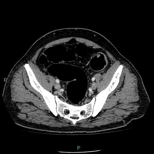 Colon adenocarcinoma with calcific liver metastasis (Radiopaedia 55745-62300 B 37).jpg