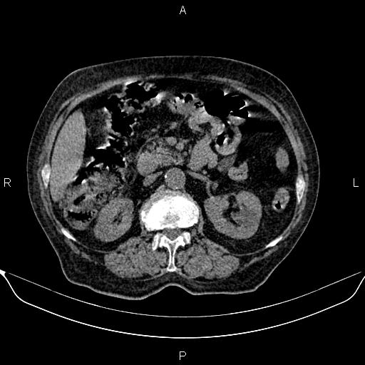 File:Colon cancer (Radiopaedia 90215-107432 Axial non-contrast 36).jpg