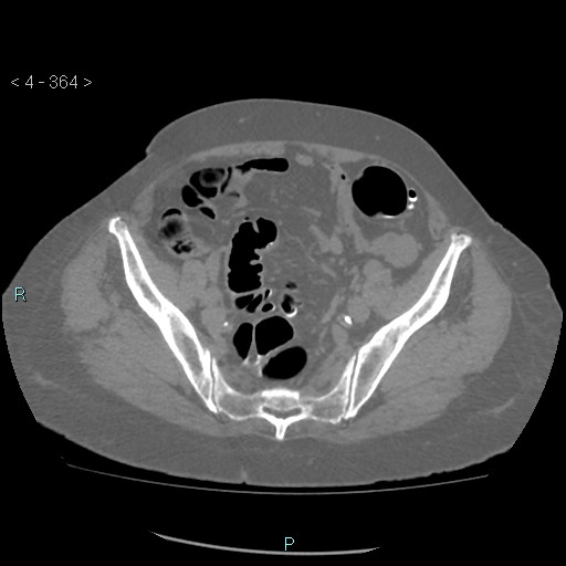 Colonic lipomas (Radiopaedia 49137-54244 Axial bone window 162).jpg