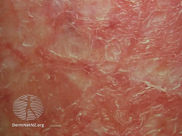 File:Eczema craquelé (DermNet NZ dermatitis-eczema-craquele6).jpg