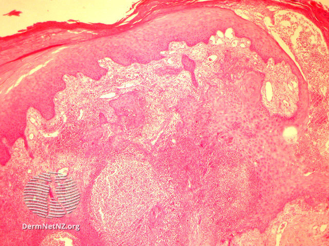 File:Figure 1 (DermNet NZ pathology-e-botryomycosis-figure-1).jpg