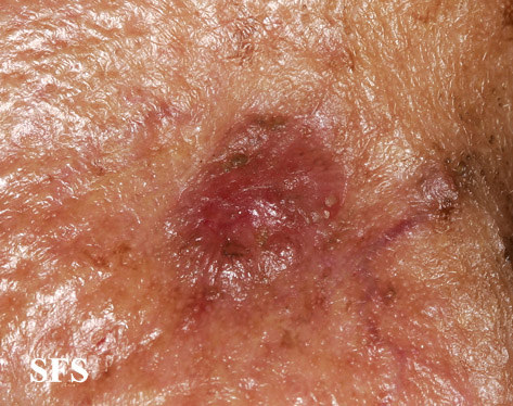 File:Melanoma (Dermatology Atlas 28).jpg