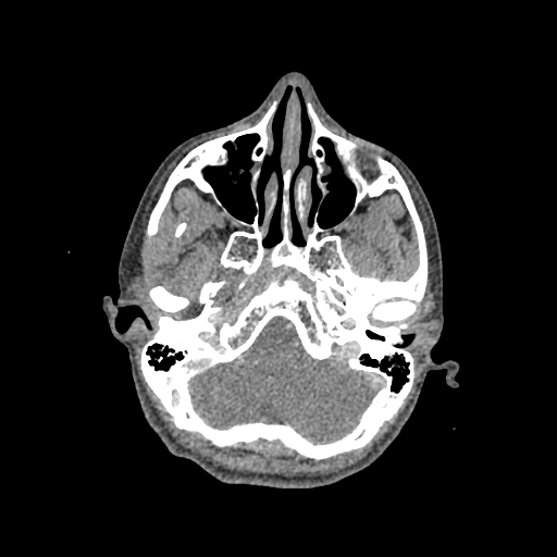 Nasal pyogenic granuloma (lobular capillary hemangioma) (Radiopaedia 85536-101244 C 75).jpg