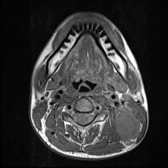 Nasopharyngeal carcinoma with skull base invasion (Radiopaedia 53415-59485 Axial T1 46).jpg