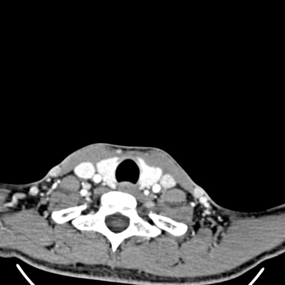 File:Nasopharyngeal carcinoma with skull base invasion (Radiopaedia 53415-59705 A 177).jpg