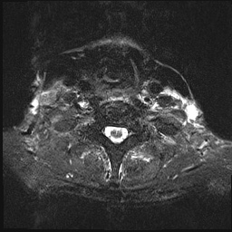 File:Nasopharyngeal carcinoma with skull base invasion (Radiopaedia 59258-66600 Axial T2 fat sat 14).jpg