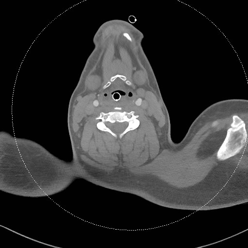 Neck CT angiogram (intraosseous vascular access) (Radiopaedia 55481-61945 B 178).jpg