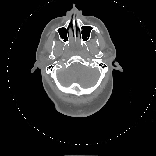 Neck CT angiogram (intraosseous vascular access) (Radiopaedia 55481-61945 B 255).jpg