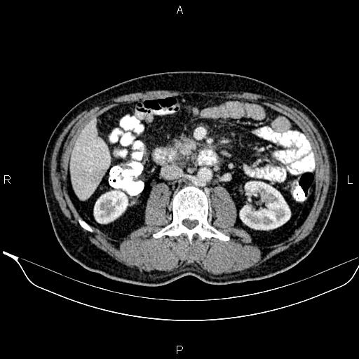 Necrotizing pancreatitis (Radiopaedia 87796-104249 A 26).jpg