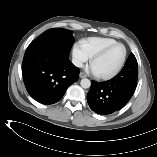 File:Necrotizing pancreatitis with acute necrotic collections (Radiopaedia 38829-41012 B 4).png