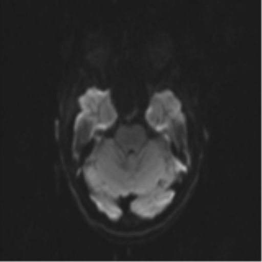 Neurenteric cyst (Radiopaedia 58641-65837 Axial DWI 46).png