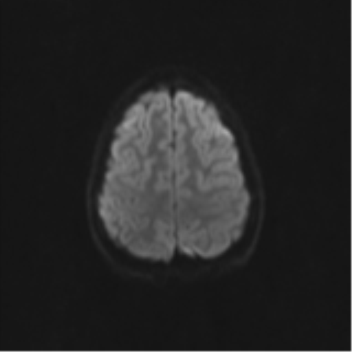 Neurenteric cyst (Radiopaedia 58641-65837 Axial DWI 63).png