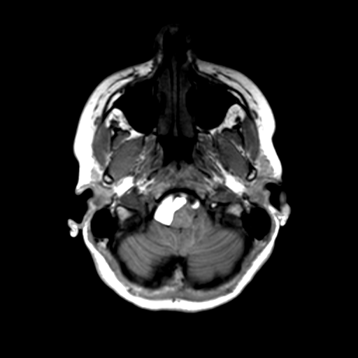 Neurenteric cyst (Radiopaedia 58641-65837 Axial T1 10).png