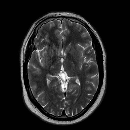 File:Neuro-Behcet's disease (Radiopaedia 21557-21506 Axial T2 14).jpg