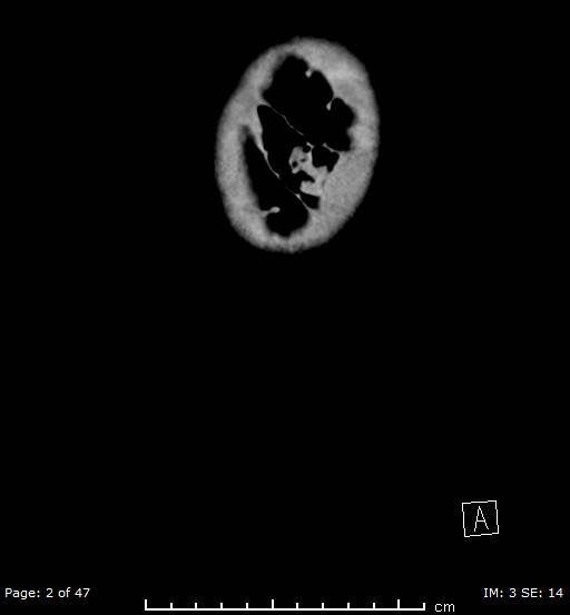File:Neuroblastoma (Radiopaedia 41472-44355 B 2).jpg