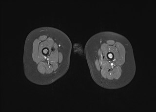 File:Neuroblastoma with bone metastases (Radiopaedia 67080-76414 Axial T1 C+ fat sat 27).jpg