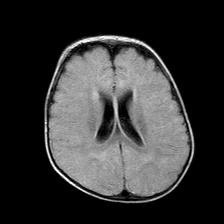File:Neurofibromatosis type 1 (Radiopaedia 30089-30671 Axial FLAIR 15).jpg