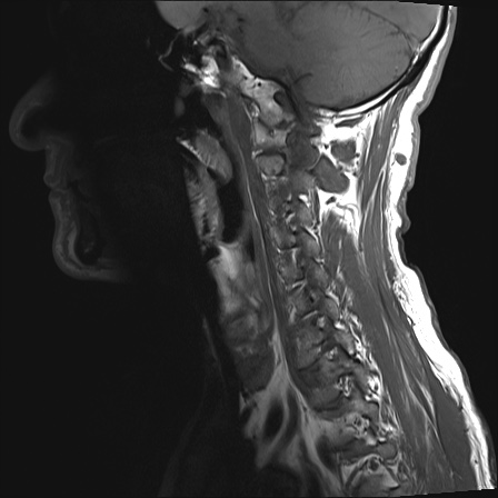 File:Neurofibromatosis type 1 (Radiopaedia 80355-93740 Sagittal T1 8).jpg