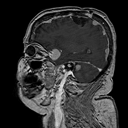 File:Neurofibromatosis type 2 (Radiopaedia 8713-9518 Sagittal T1 C+ 16).jpg