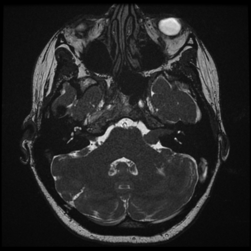Neurofibromatosis type 2 - bilateral acoustic neuromata (Radiopaedia 40060-42566 Axial FIESTA 37).png