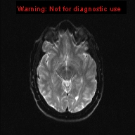 File:Neuroglial cyst (Radiopaedia 10713-11184 Axial DWI 13).jpg