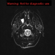 File:Neuroglial cyst (Radiopaedia 10713-11184 Axial DWI 21).jpg