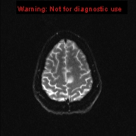 File:Neuroglial cyst (Radiopaedia 10713-11184 Axial DWI 4).jpg