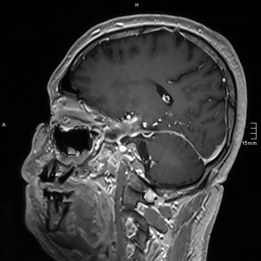 Neurosarcoidosis - involvement of the mesial temporal lobes (Radiopaedia 67429-76820 Sagittal T1 C+ 103).jpg