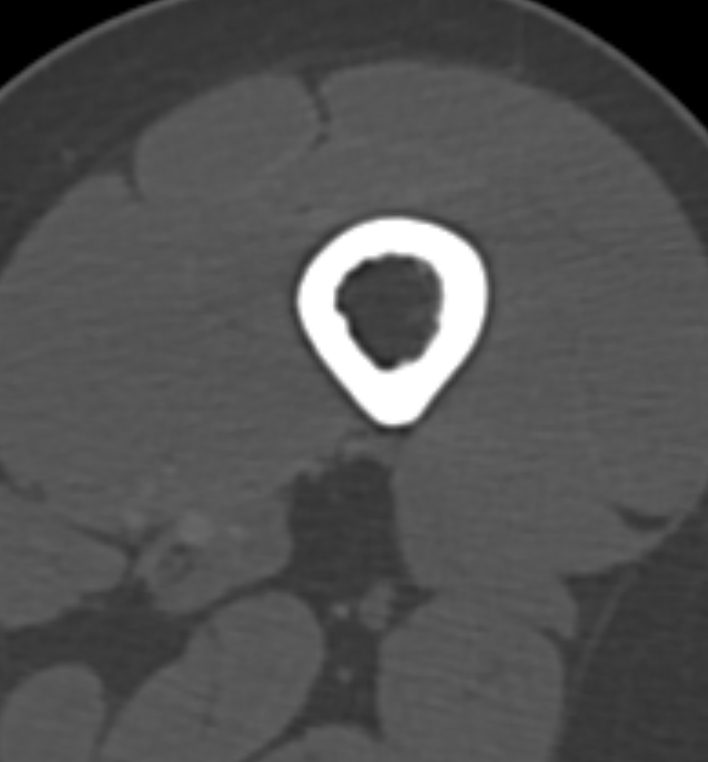 Non-ossifying fibroma - femur (Radiopaedia 82786-97042 Axial bone window 16).jpg